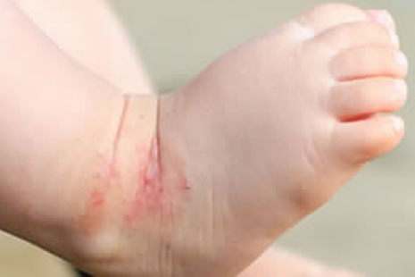 Baby with eczema on foot